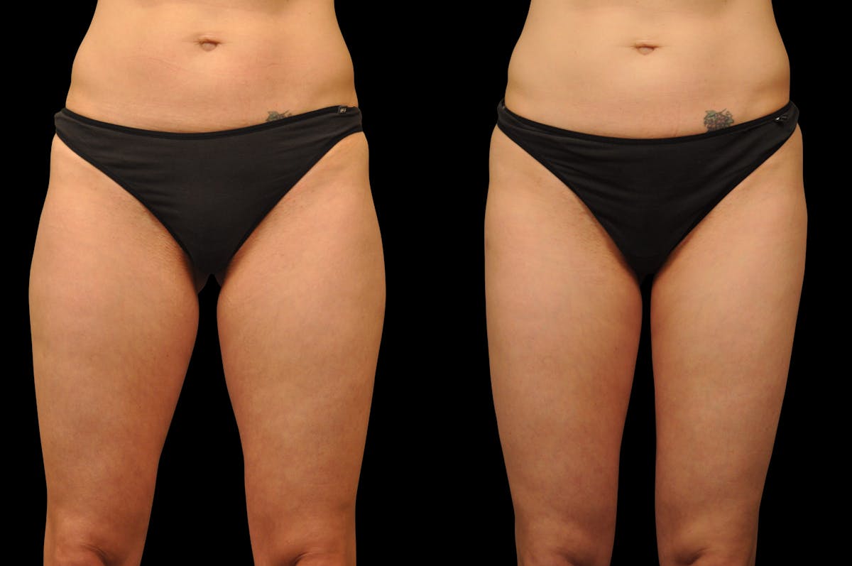 Liposuction / BodyTite Before & After Gallery - Patient 240195 - Image 2