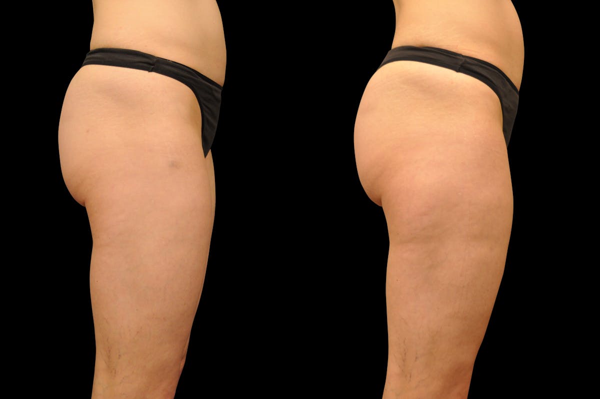 BodyTite - Thigh Before & After Gallery - Patient 299534 - Image 3