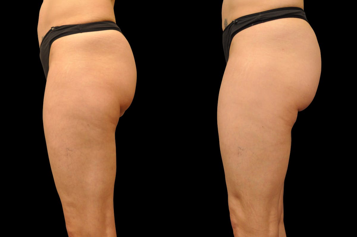 Liposuction / BodyTite Before & After Gallery - Patient 240195 - Image 4