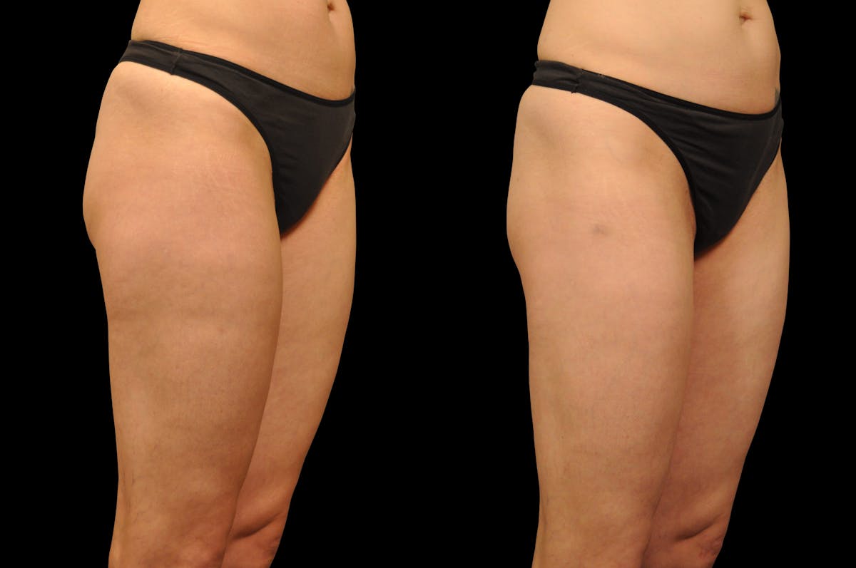 Liposuction / BodyTite Before & After Gallery - Patient 240195 - Image 6
