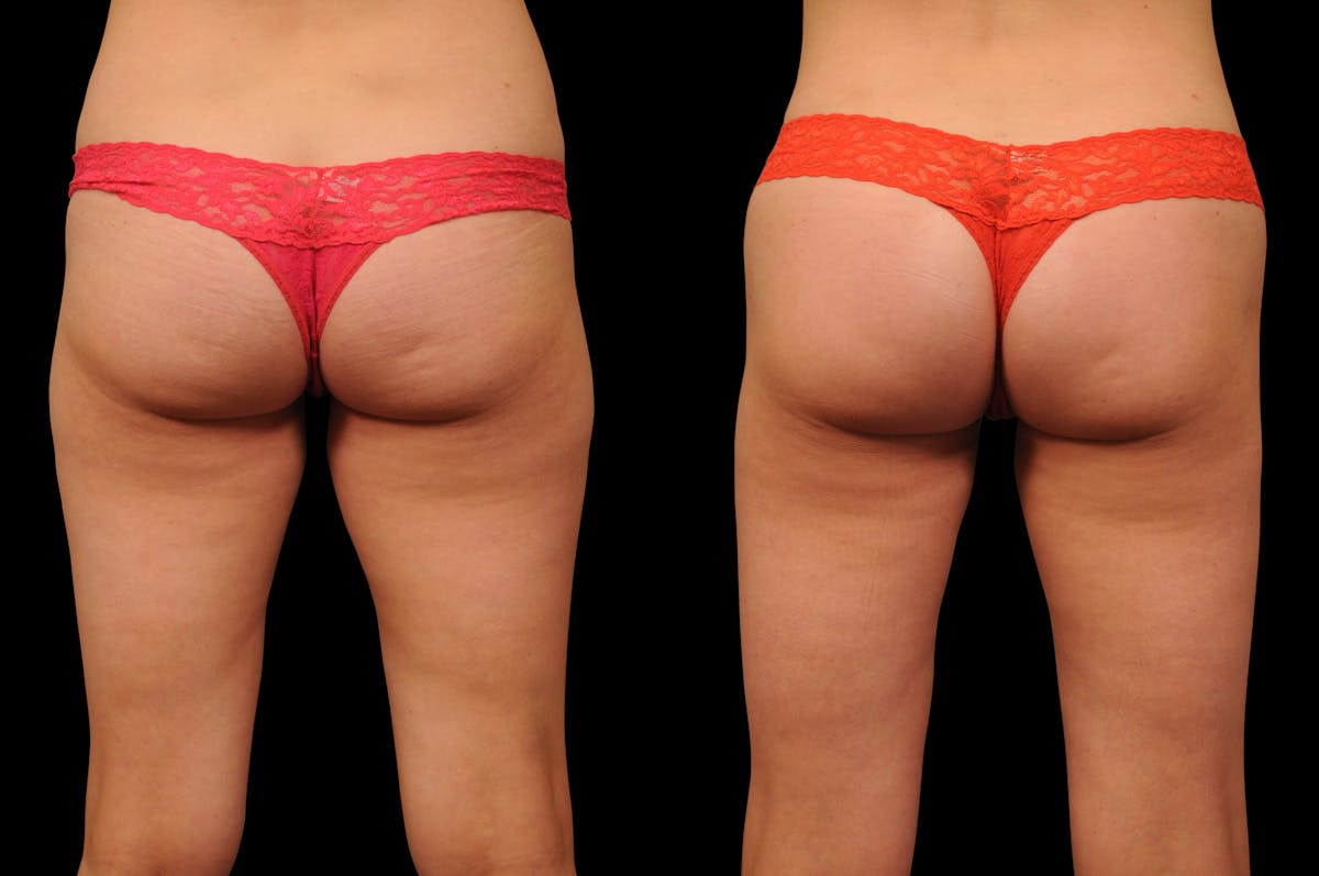 Liposuction / BodyTite Before & After Gallery - Patient 553250 - Image 1