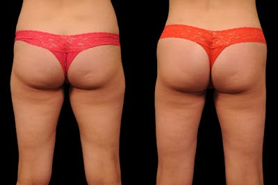 BodyTite - Thigh Before & After Gallery - Patient 206539 - Image 1