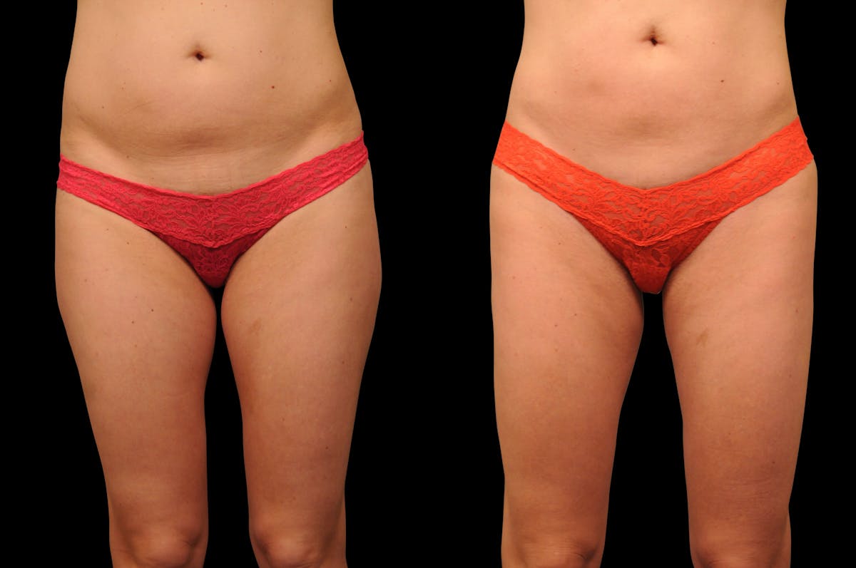 Liposuction / BodyTite Before & After Gallery - Patient 553250 - Image 2