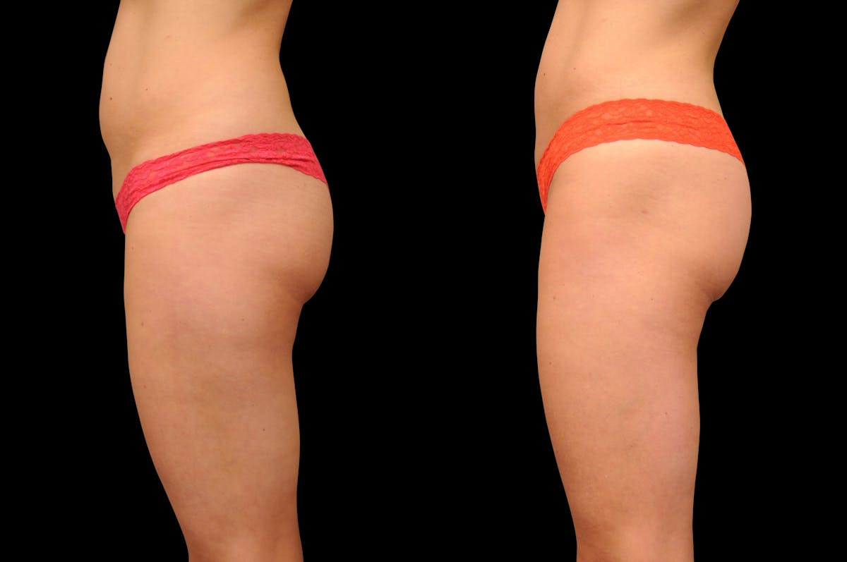 BodyTite - Thigh Before & After Gallery - Patient 206539 - Image 3