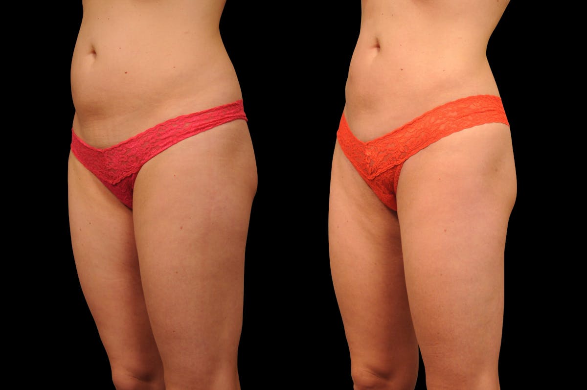 Liposuction / BodyTite Before & After Gallery - Patient 553250 - Image 4