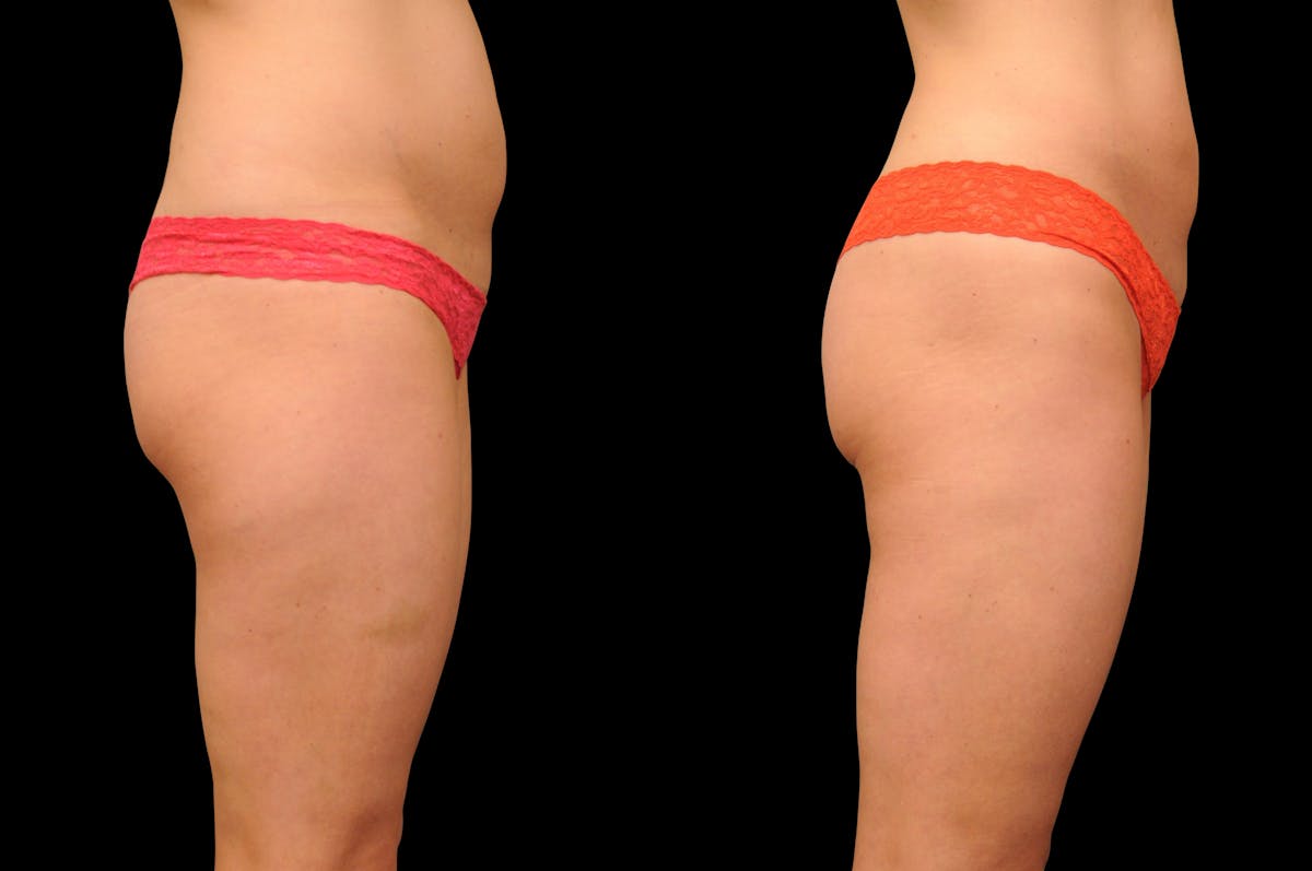 Liposuction / BodyTite Before & After Gallery - Patient 553250 - Image 5