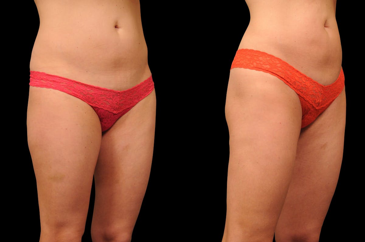 Liposuction / BodyTite Before & After Gallery - Patient 553250 - Image 6