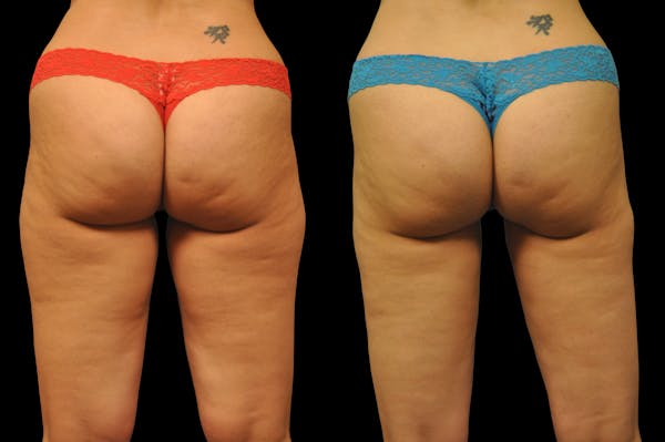 Liposuction / BodyTite Before & After Gallery - Patient 177546 - Image 1