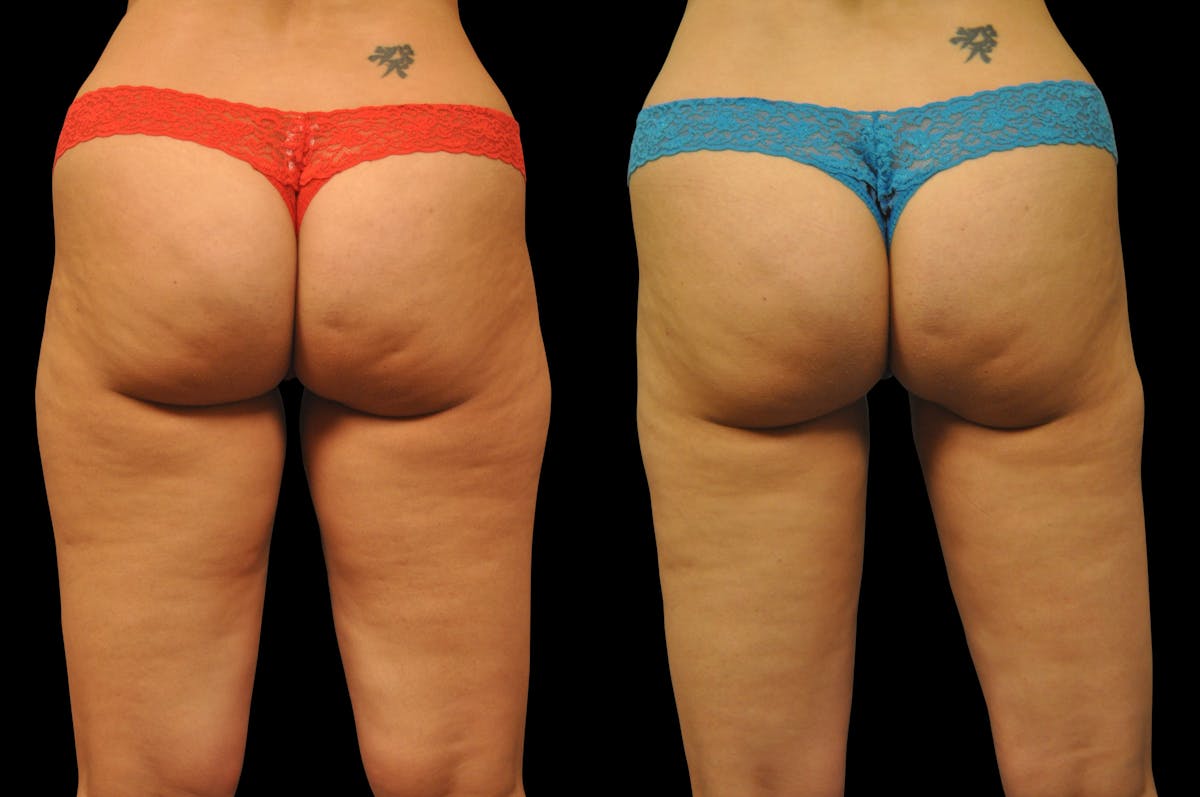BodyTite - Thigh Before & After Gallery - Patient 977822 - Image 1