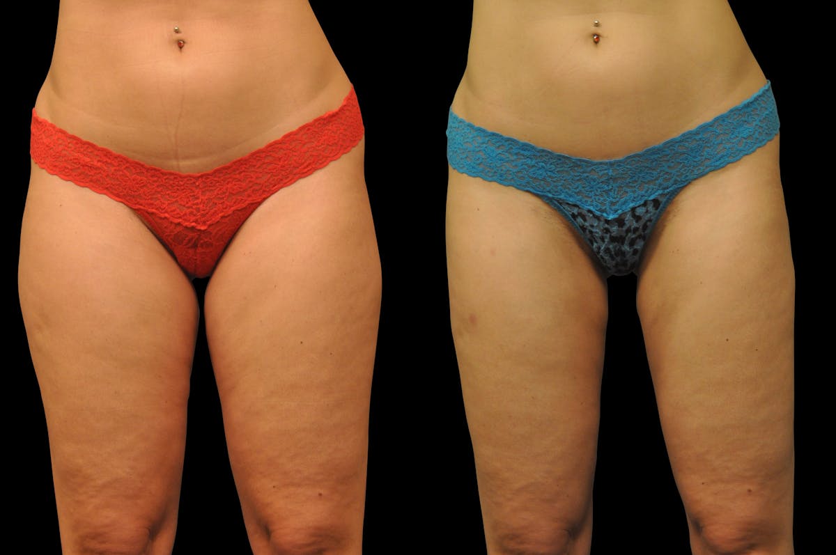 Liposuction / BodyTite Before & After Gallery - Patient 177546 - Image 2