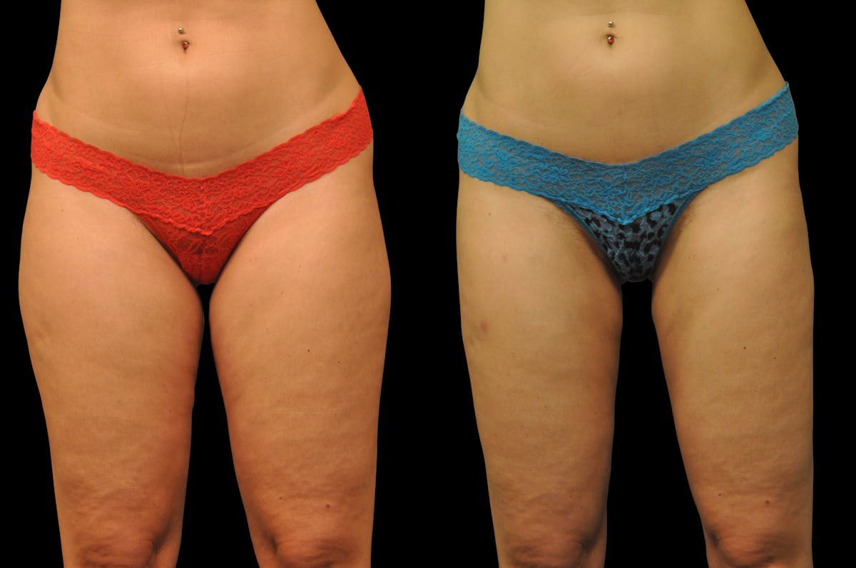 BodyTite - Thigh Before & After Gallery - Patient 977822 - Image 2
