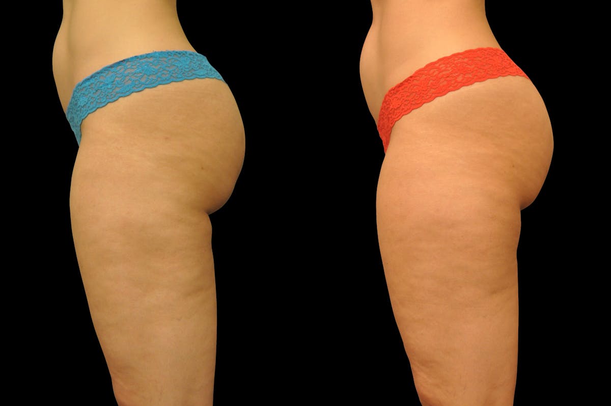 Liposuction / BodyTite Before & After Gallery - Patient 177546 - Image 3