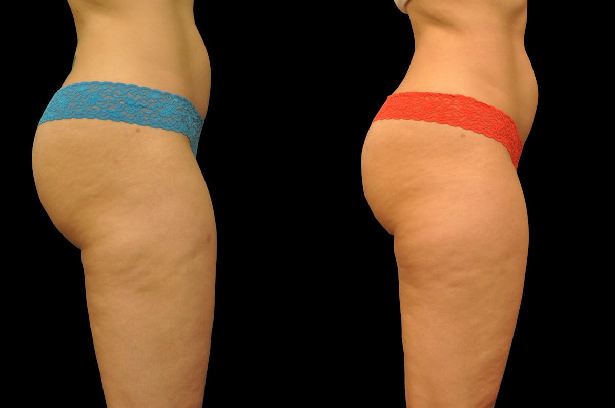 Liposuction / BodyTite Before & After Gallery - Patient 177546 - Image 4