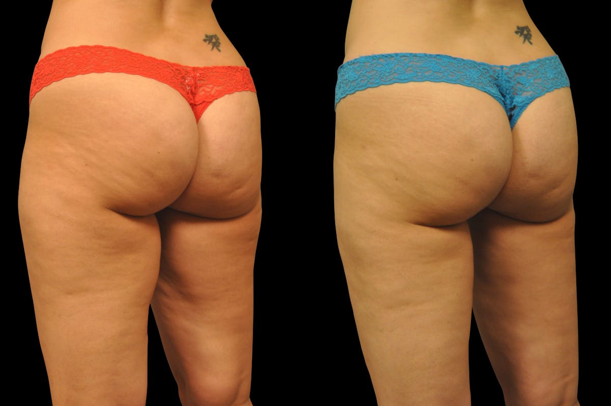 Liposuction / BodyTite Before & After Gallery - Patient 177546 - Image 5