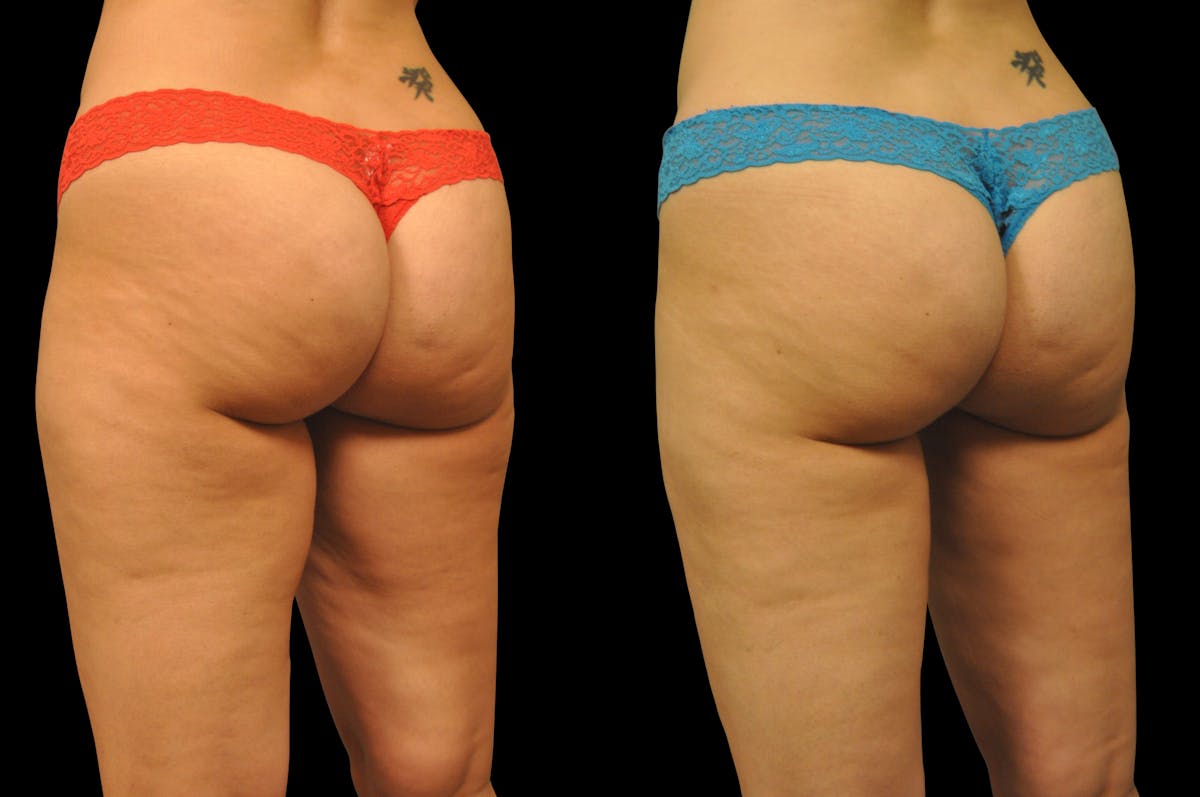 BodyTite - Thigh Before & After Gallery - Patient 977822 - Image 5