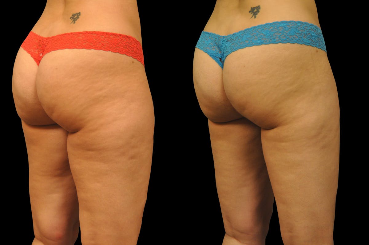 BodyTite - Thigh Before & After Gallery - Patient 977822 - Image 6