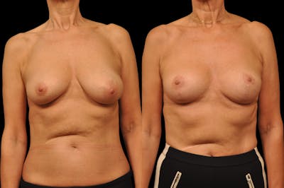 Breast Lift Before & After Gallery - Patient 309311 - Image 1