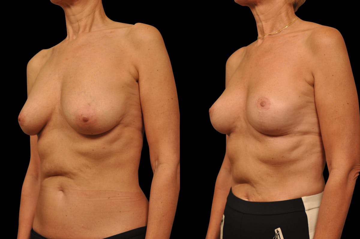 Breast Lift Before & After Gallery - Patient 309311 - Image 2