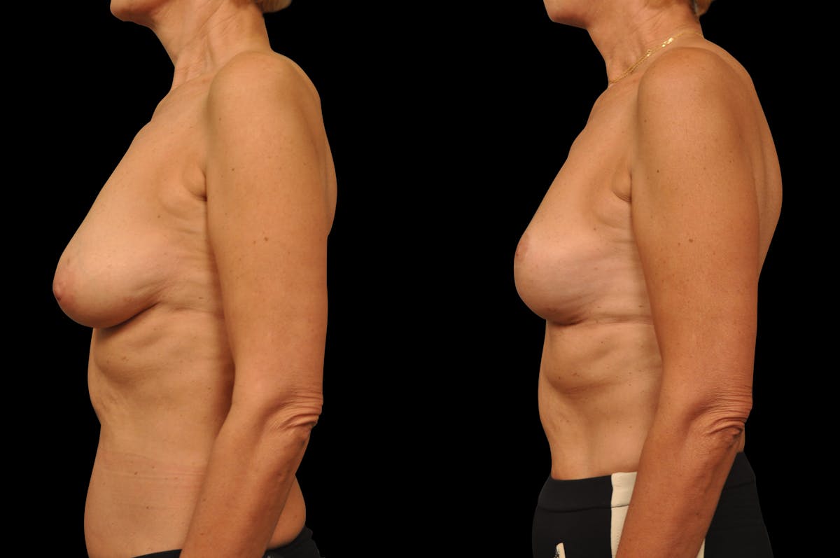 Breast Lift Before & After Gallery - Patient 309311 - Image 3