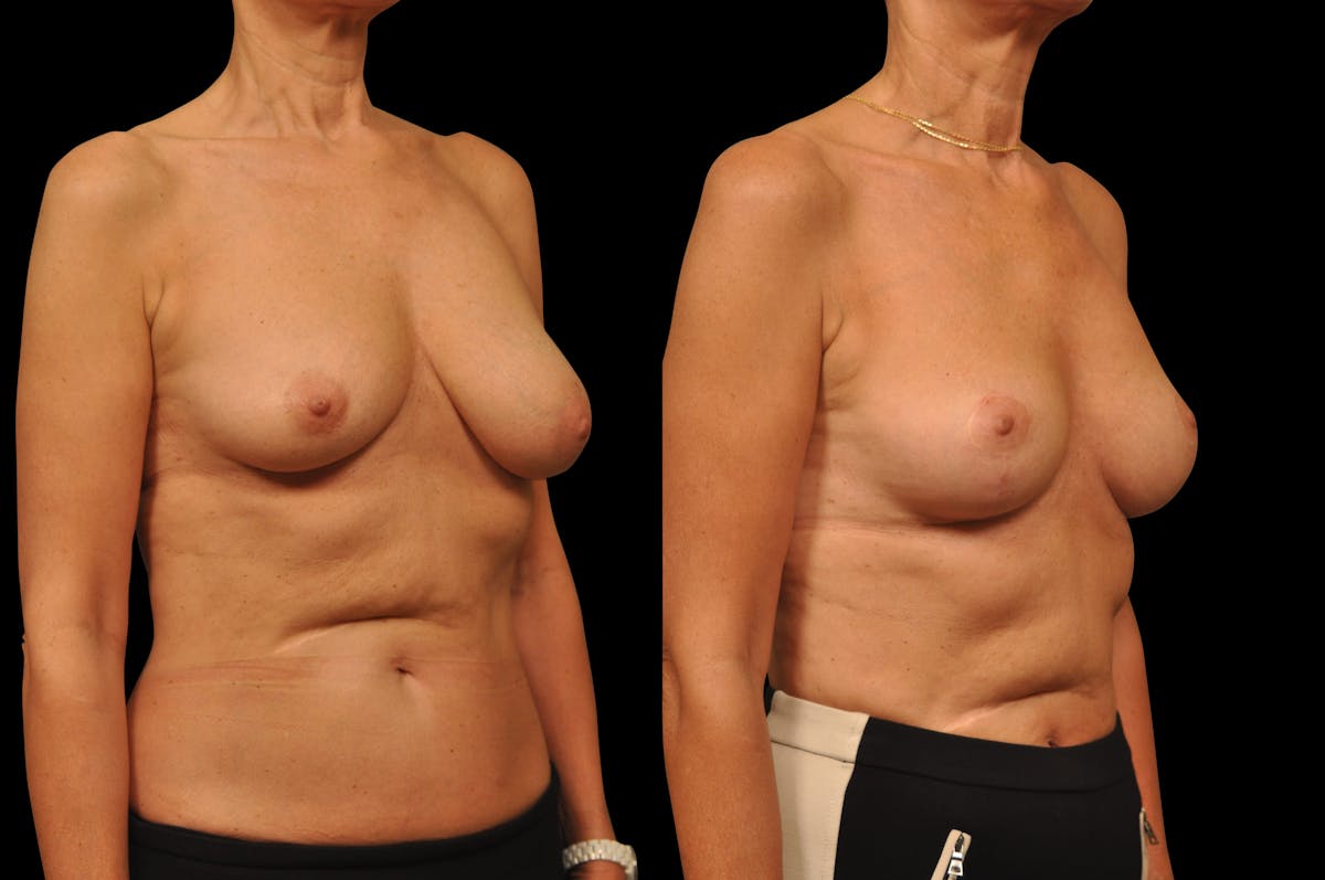 Breast Lift Before & After Gallery - Patient 309311 - Image 4