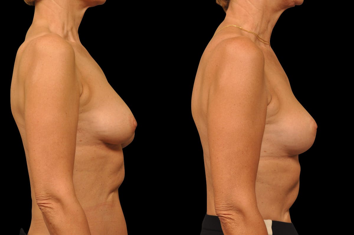 Breast Lift Before & After Gallery - Patient 309311 - Image 5