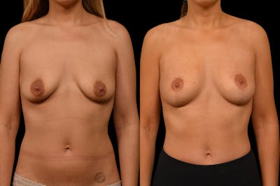 Breast Lift Before & After Gallery - Patient 389712 - Image 1
