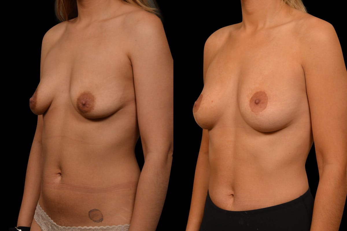Breast Lift Before & After Gallery - Patient 389712 - Image 2