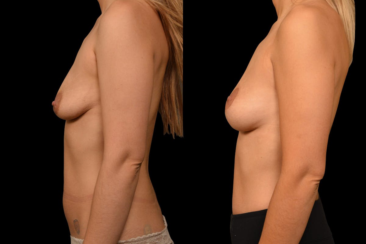 Breast Lift Before & After Gallery - Patient 389712 - Image 3