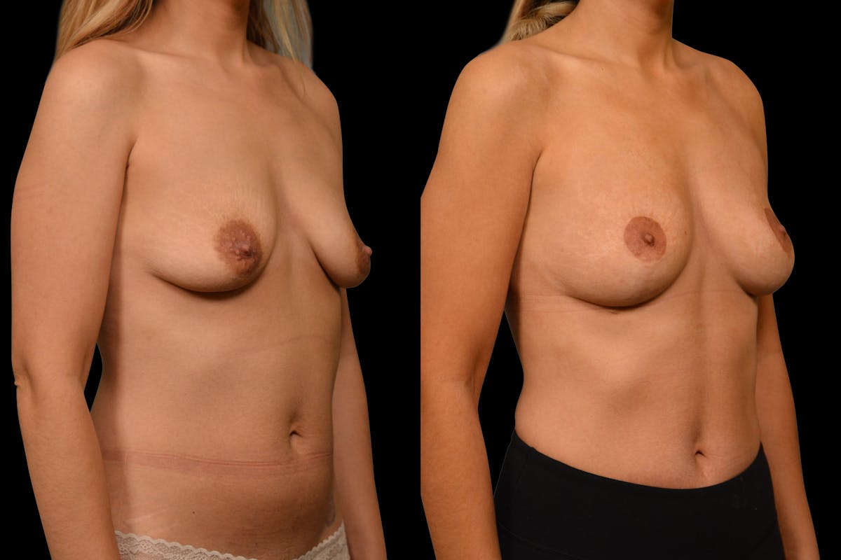 Breast Lift Before & After Gallery - Patient 389712 - Image 4