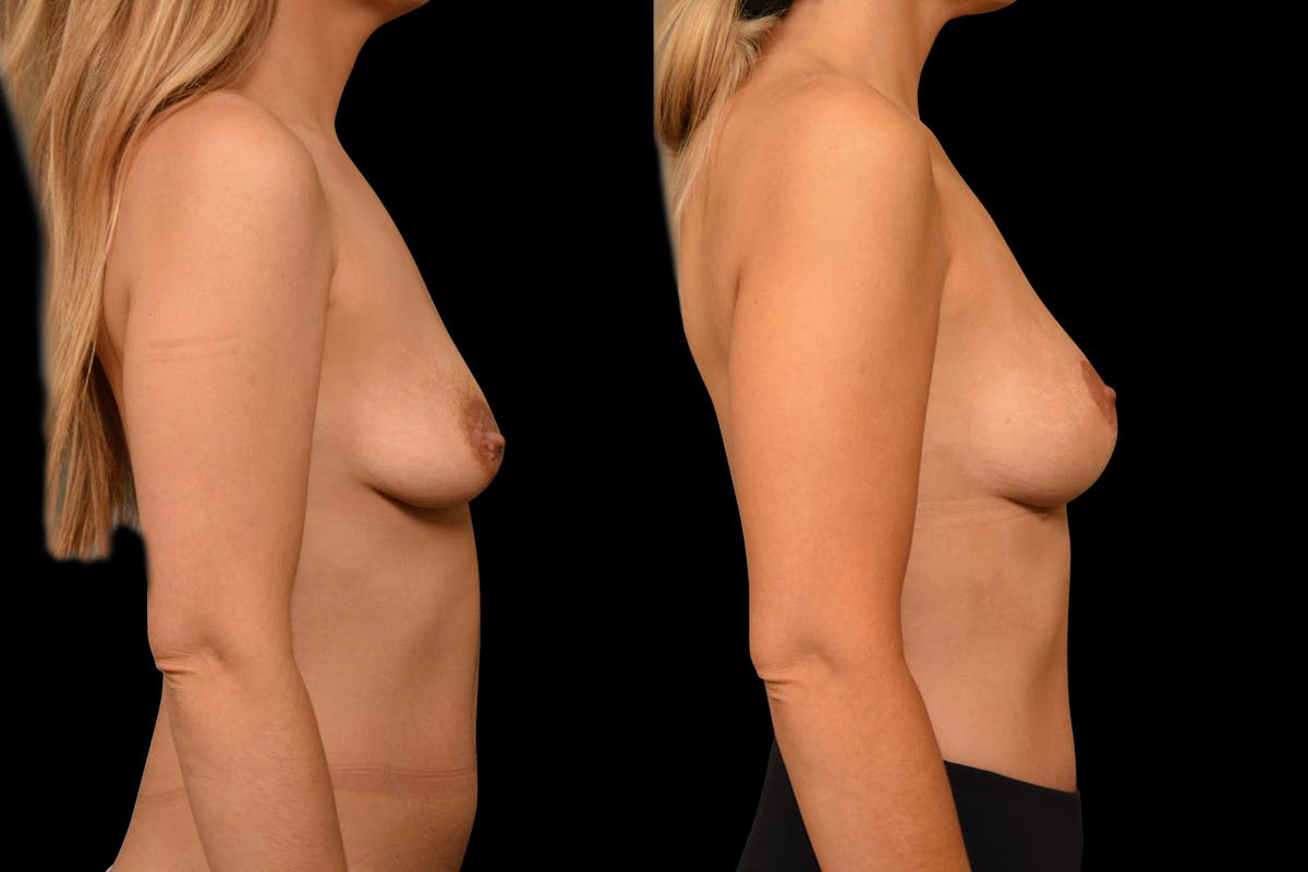 Breast Lift Before & After Gallery - Patient 389712 - Image 5