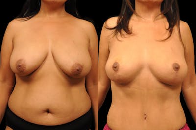 Breast Lift Before & After Gallery - Patient 377254 - Image 1