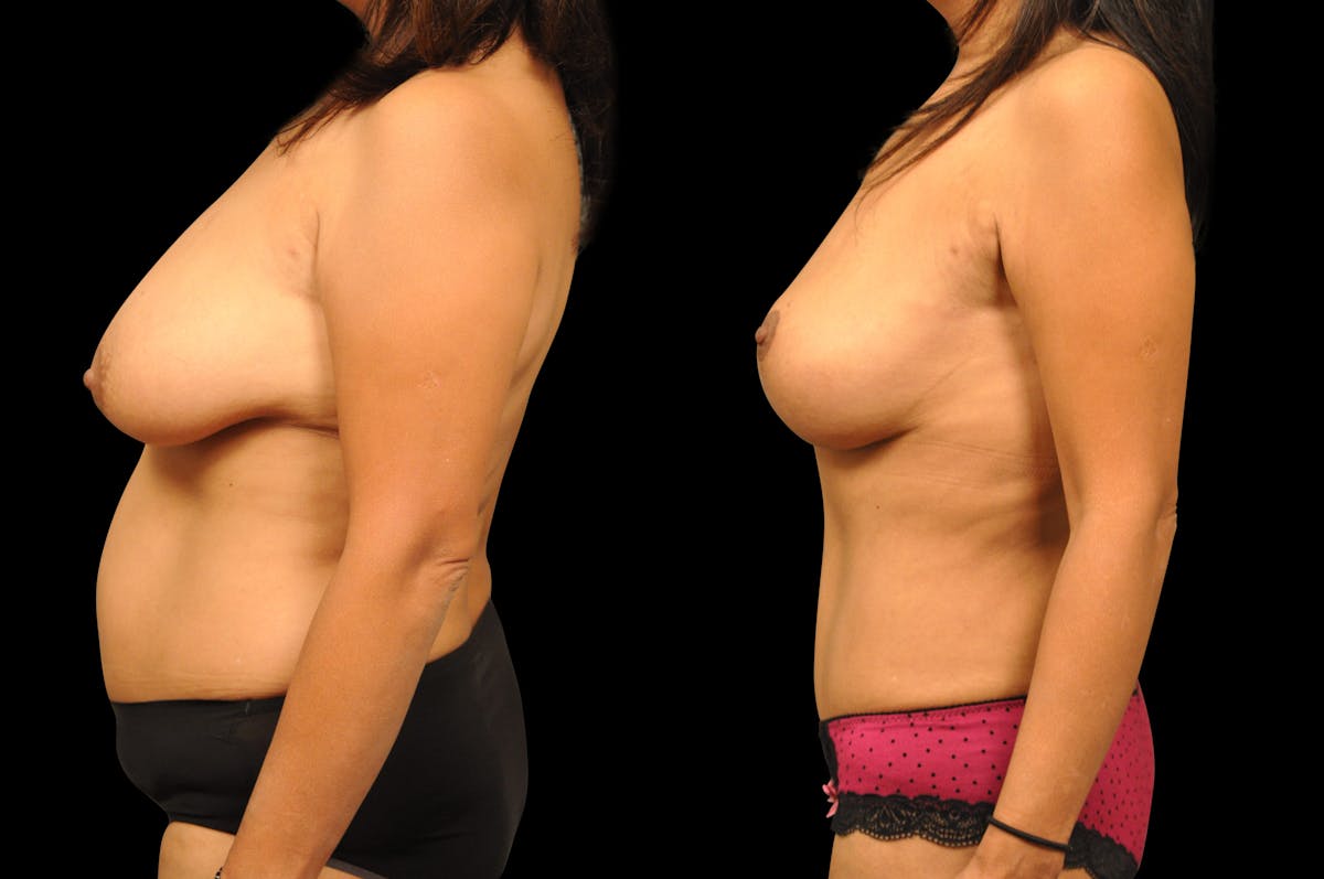 Breast Lift Before & After Gallery - Patient 377254 - Image 3
