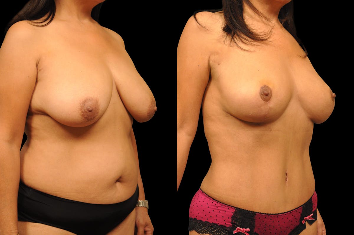 Breast Lift Before & After Gallery - Patient 377254 - Image 4