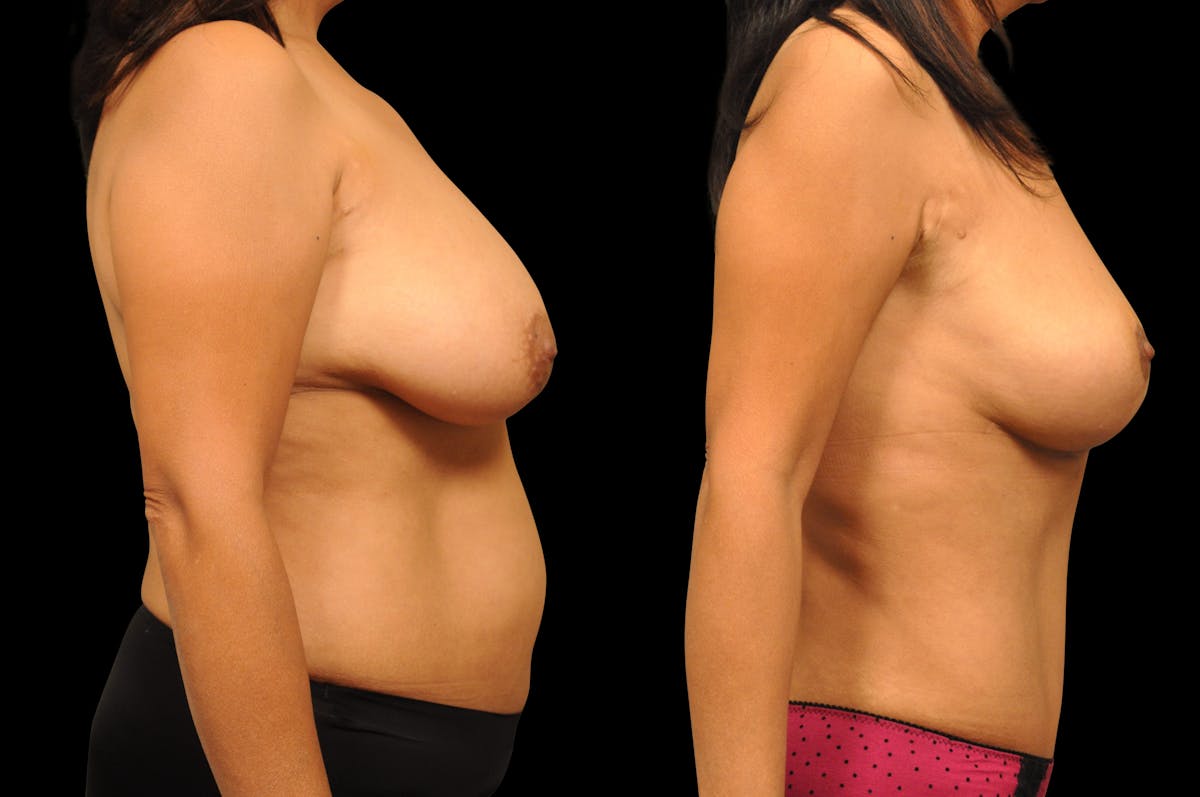 Breast Lift Before & After Gallery - Patient 377254 - Image 5