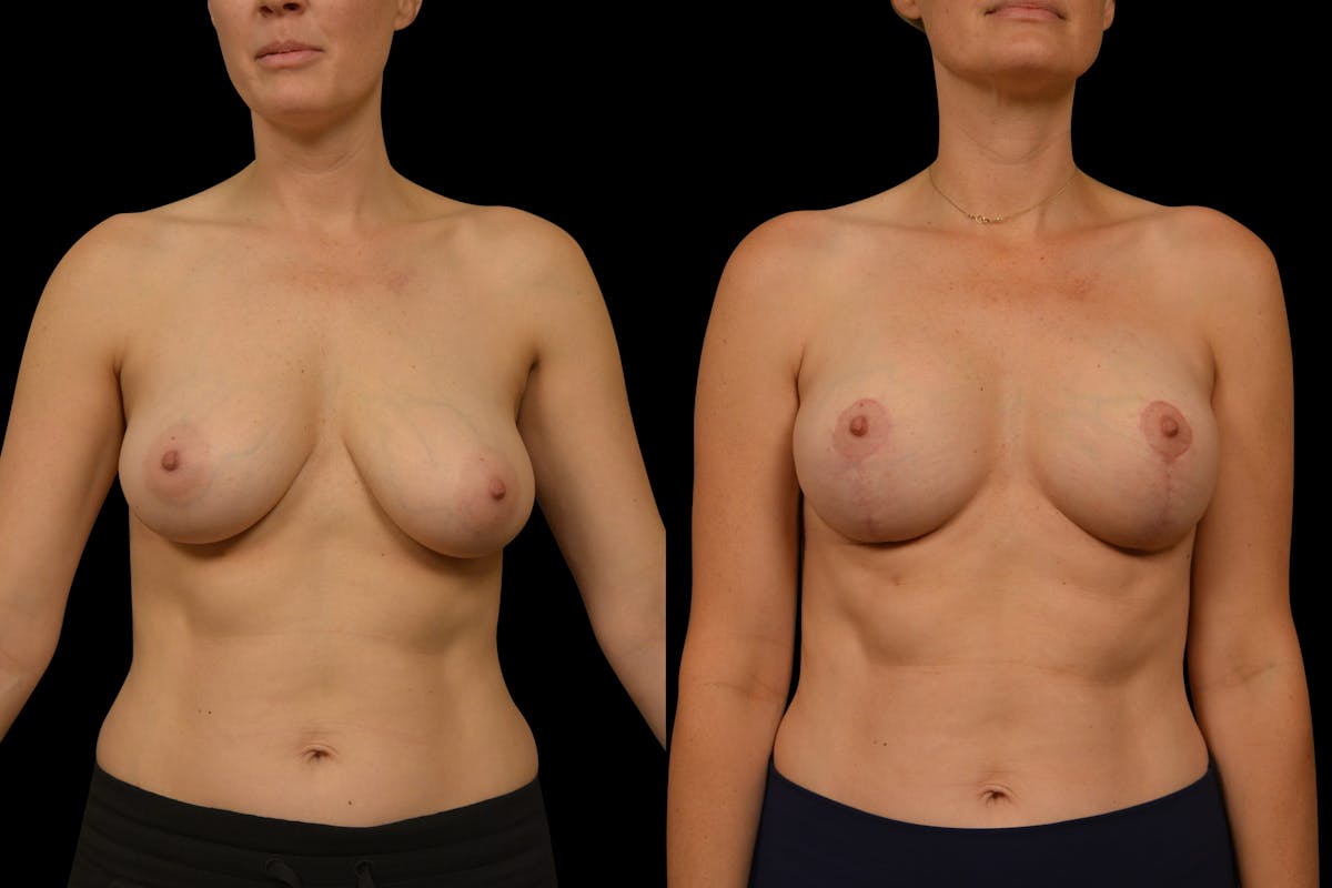 Breast Lift Before & After Gallery - Patient 248067 - Image 1