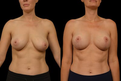 Breast Lift Before & After Gallery - Patient 248067 - Image 1