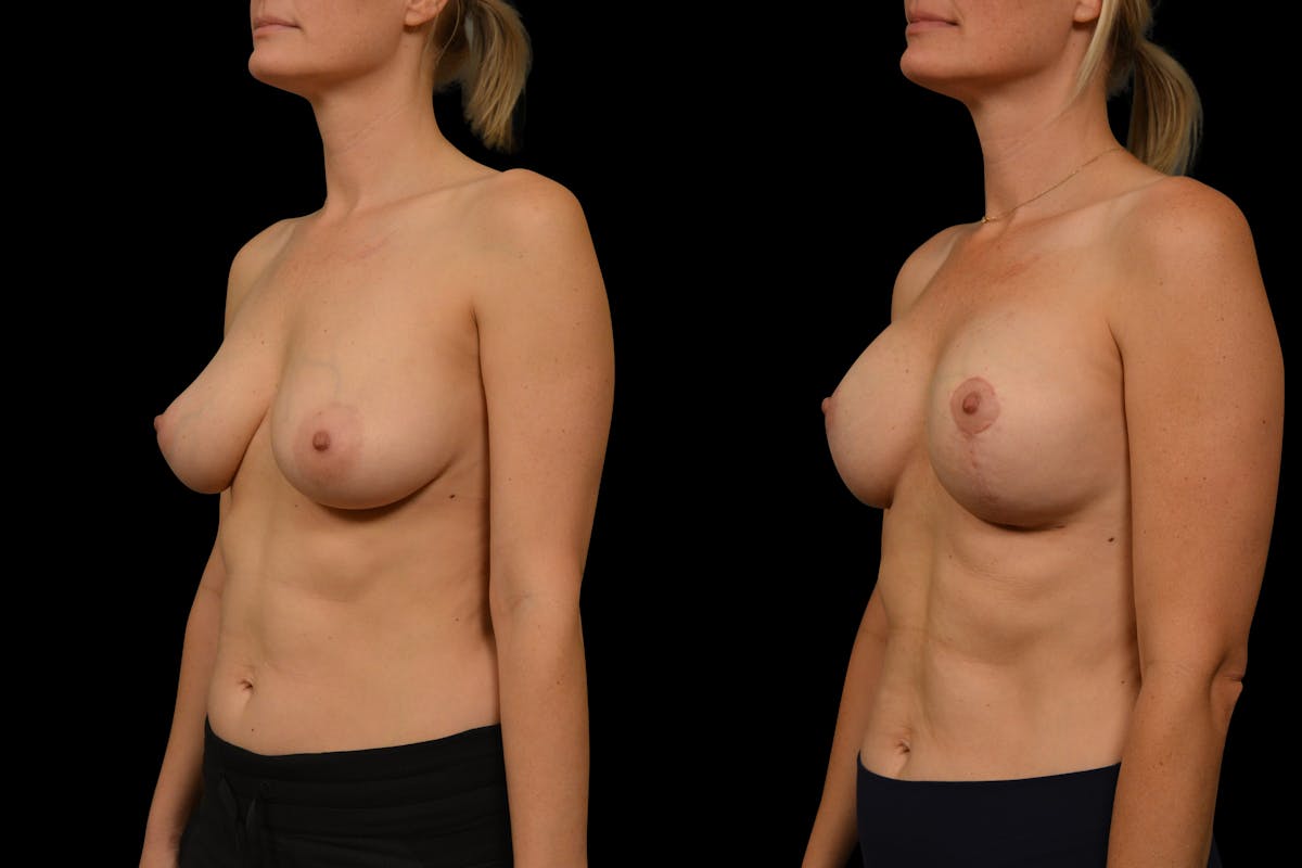 Breast Lift Before & After Gallery - Patient 248067 - Image 2