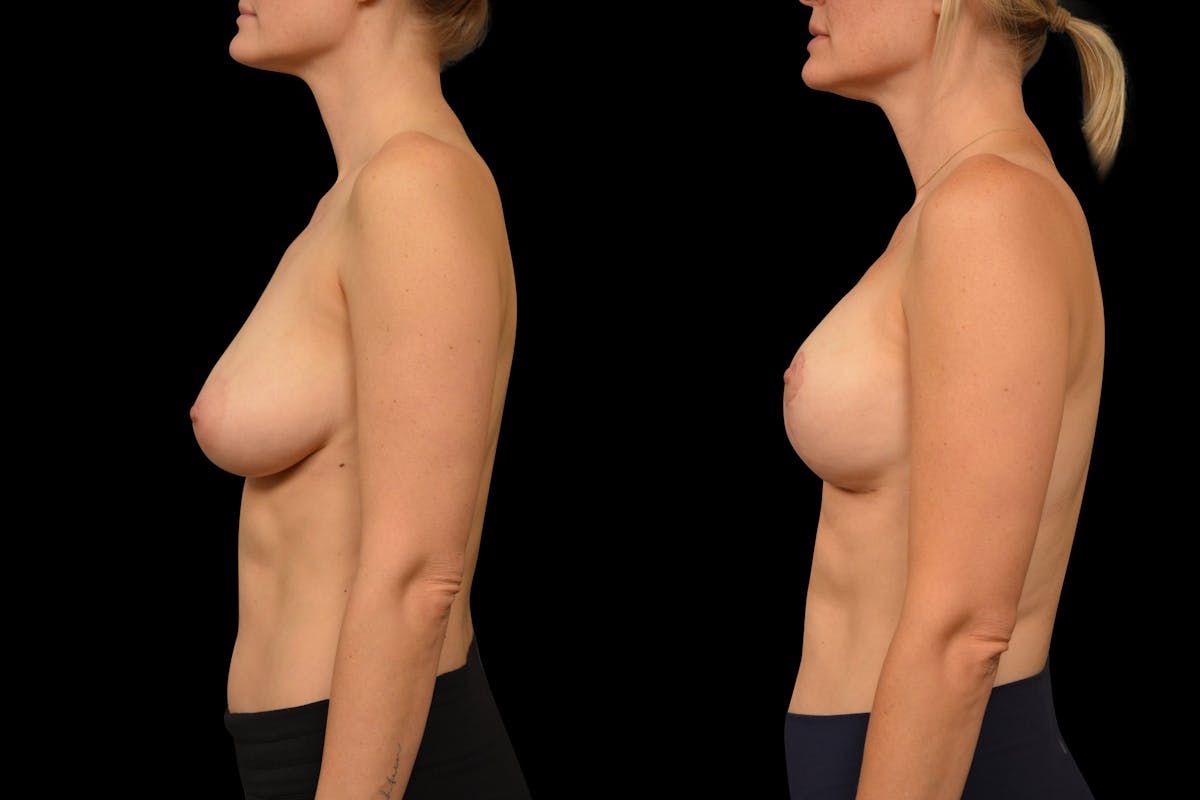 Breast Lift Before & After Gallery - Patient 248067 - Image 3