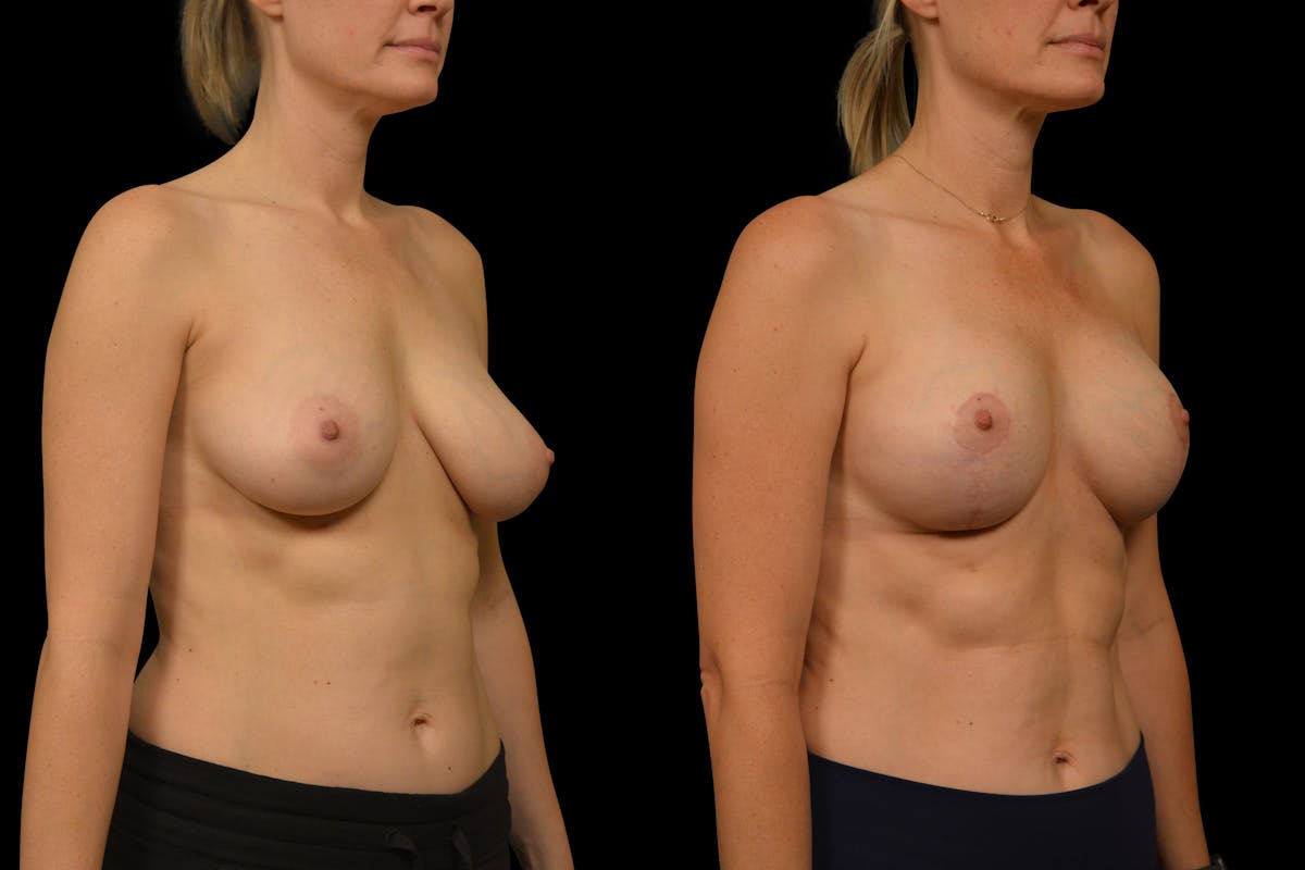 Breast Lift Before & After Gallery - Patient 248067 - Image 4