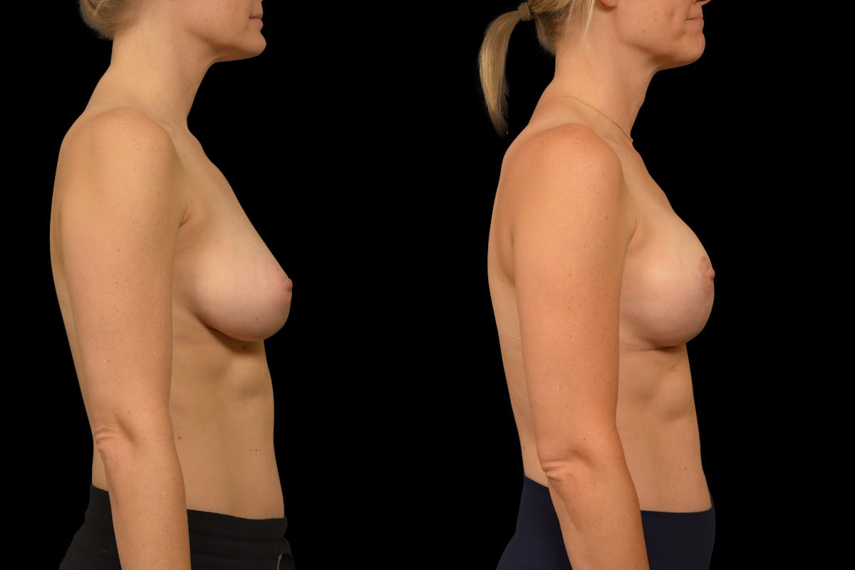 Breast Lift Before & After Gallery - Patient 248067 - Image 5