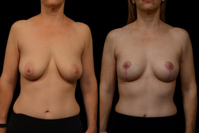 Breast Lift Before & After Gallery - Patient 110987 - Image 1