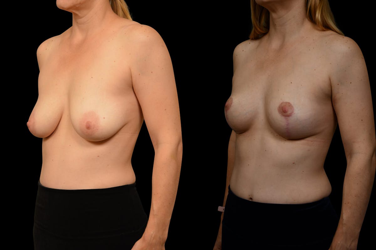 Breast Lift Before & After Gallery - Patient 110987 - Image 2