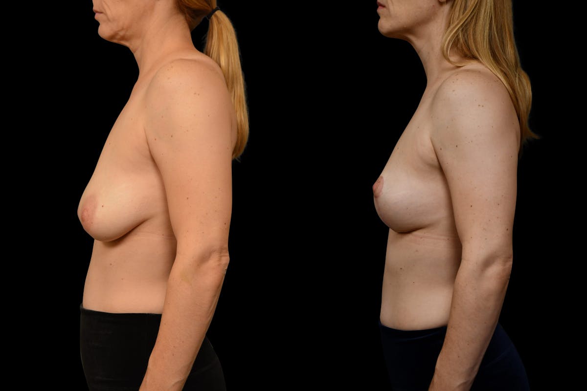 Breast Lift Before & After Gallery - Patient 110987 - Image 3