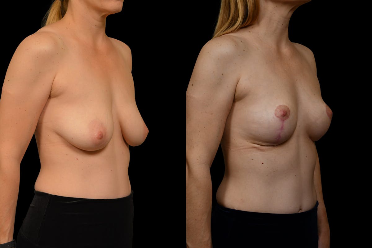 Breast Lift Before & After Gallery - Patient 110987 - Image 4