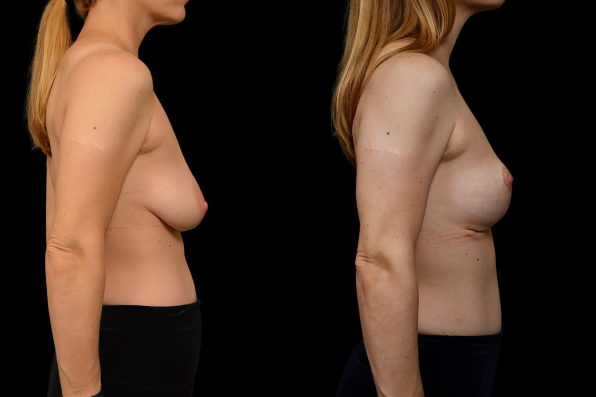 Breast Lift Before & After Gallery - Patient 110987 - Image 5
