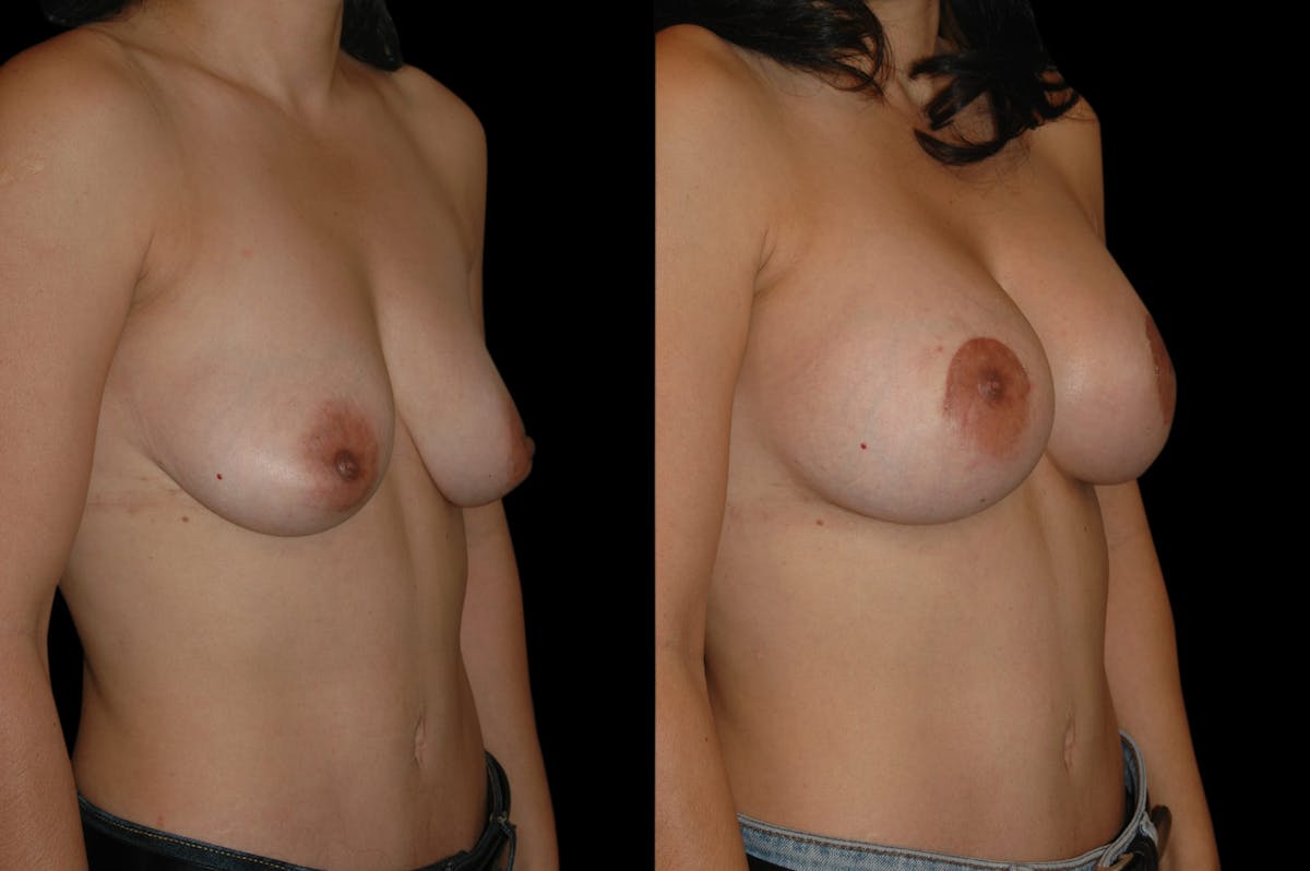 Breast Lift with Augmentation Before & After Gallery - Patient 332450 - Image 2