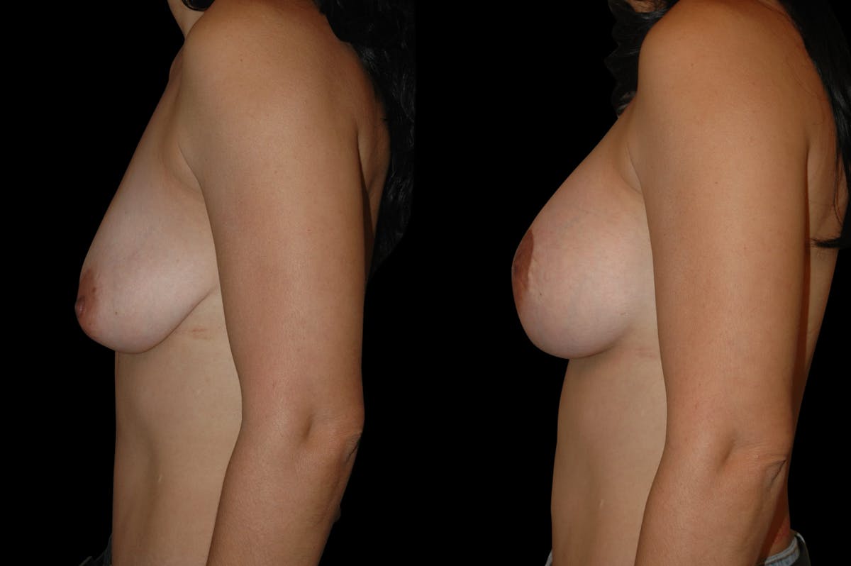 Breast Lift with Augmentation Before & After Gallery - Patient 332450 - Image 3
