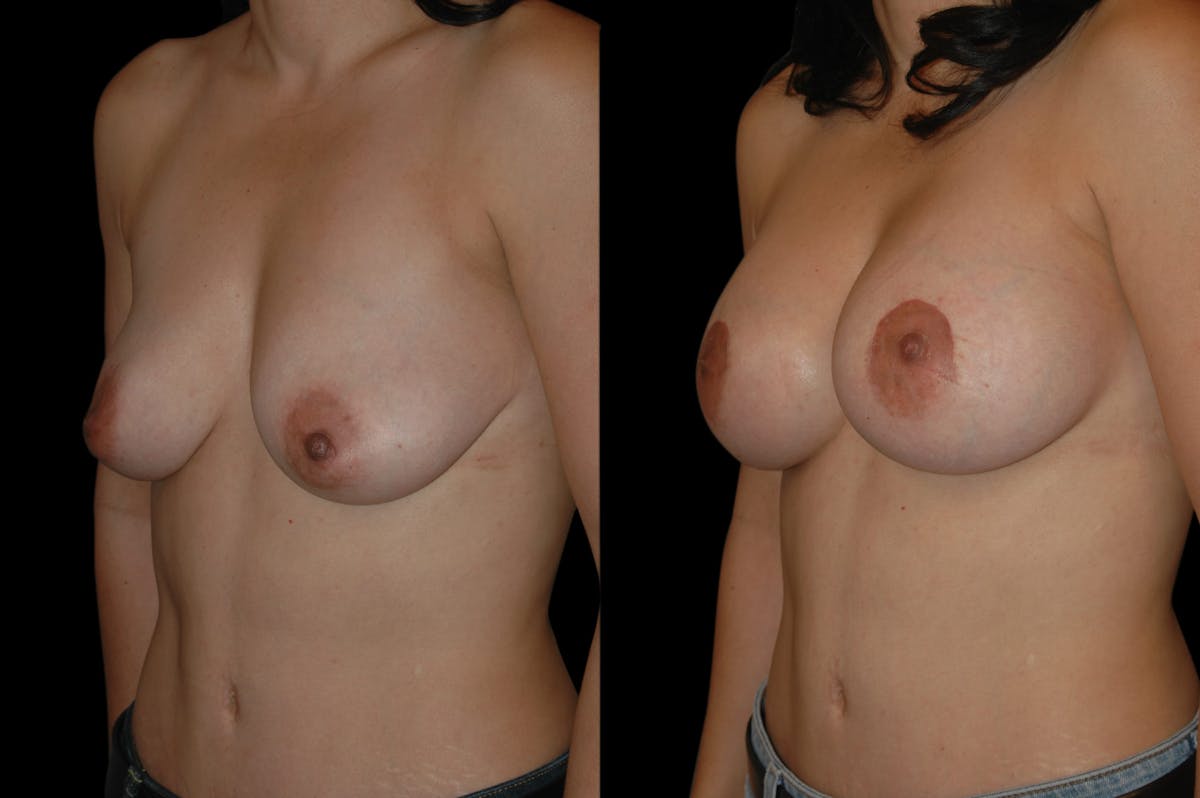 Breast Lift with Augmentation Before & After Gallery - Patient 332450 - Image 4