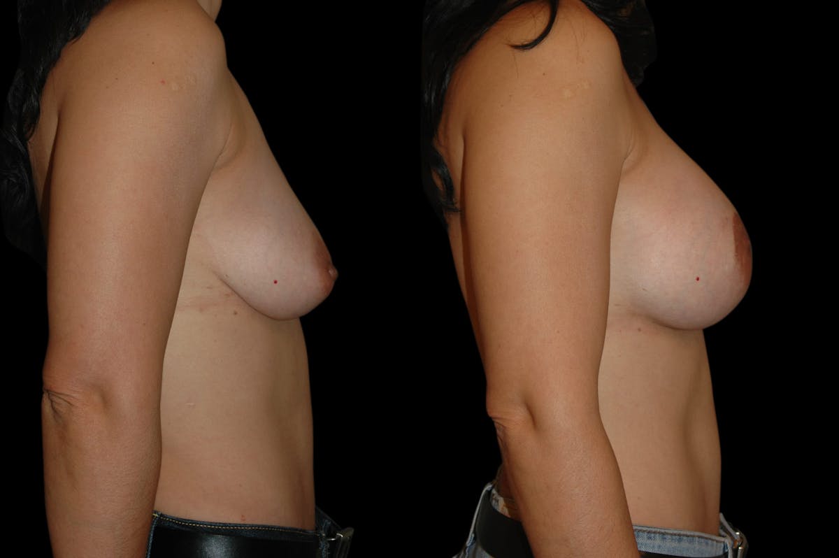 Breast Lift Before & After Gallery - Patient 108021 - Image 5