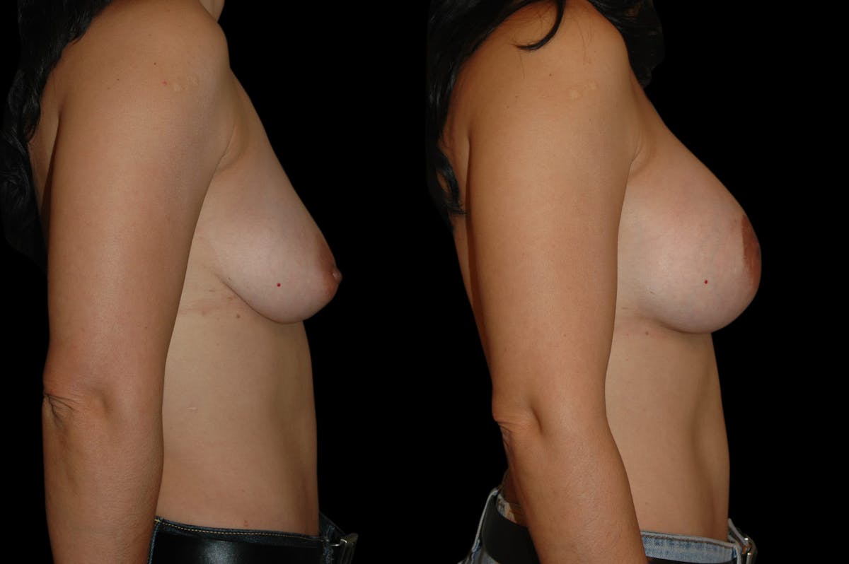 Breast Lift with Augmentation Before & After Gallery - Patient 332450 - Image 5